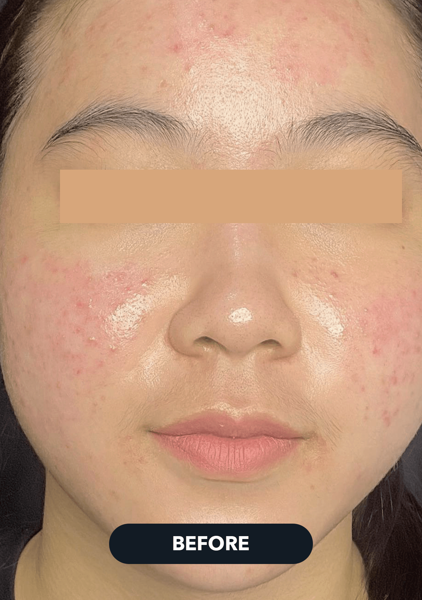 Before Acne