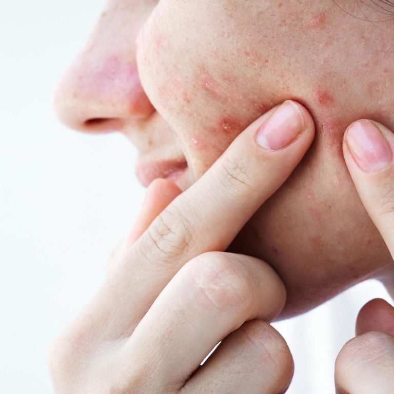 young woman presses acne and pimples on skin on face with fingers. Teenager girl with problematic skin close-up on isolated white background